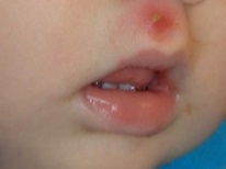 어린이의 피부에있는 포진 구내염