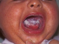 Thrush v ústach novorodencov