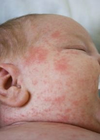 Алергия при бебета да се смесва