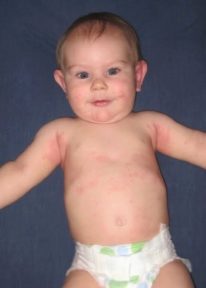 Алергия при бебета да се смесва