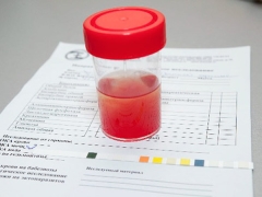 Erytrocyten in de urine van een kind