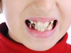 Oorzaken van zwarte plaque op de tanden van kinderen