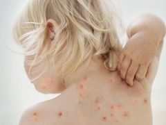 Cosa e come puoi alleviare il prurito della varicella?