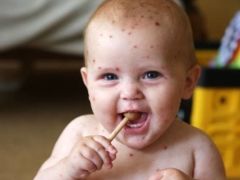 Come inizia la varicella: i primi segni