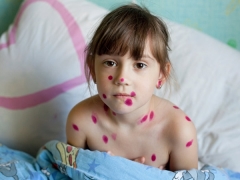 È possibile camminare un bambino con la varicella