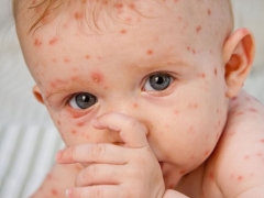 Cos'è la varicella e come trattarla nei bambini?