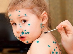 Sintomi, segni e trattamento della varicella nei bambini