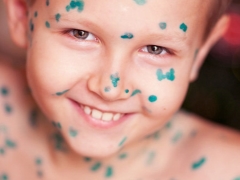 How and what to treat chickenpox at home?