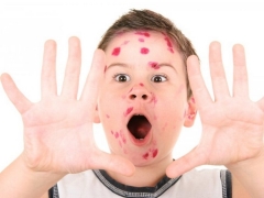 How to find out if a person has had chickenpox: everything about the analysis of antibodies to chickenpox