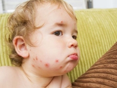 Prevenzione della varicella