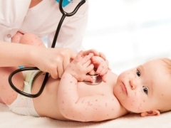 Possibili complicazioni dopo la varicella nei bambini
