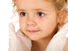 बच्चों में रूबेला: लक्षण, उपचार और रोकथाम