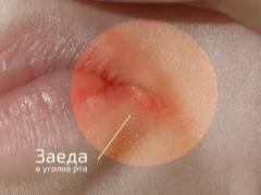 Angulit i munens hörn hos barn