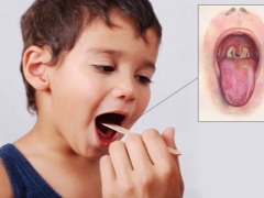 Symptomen, behandeling en preventie van difterie bij kinderen