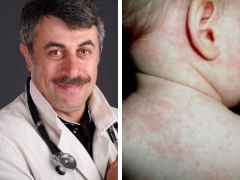Dr Komarovsky over herpes type 6 bij kinderen