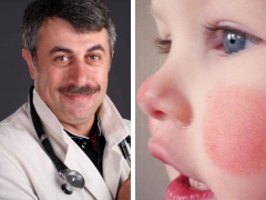 Dr. Komarovsky over rode wangen bij een kind