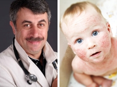 어린이의 아토피 성 피부염 치료에 대한 Komarovsky 박사