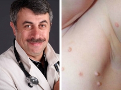 Dr. Komarovsky on the treatment of children with molluscum contagiosum