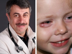 보모를 아이의 눈으로 치료하는 방법에 관한 Dr. Komarovsky