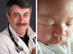 신생아의 여드름에 관한 Dr. Komarovsky