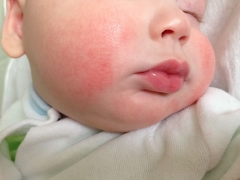 아기의 피부 알레르기는 어떻게 생겼습니까?