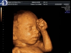 4D-ultraljud under graviditeten