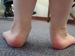 Deformità del piede varo nei bambini