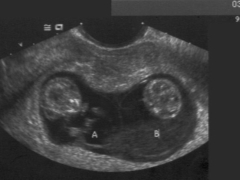 Vad är fetal CTP, och hur ska det vara normalt under graviditeten?
