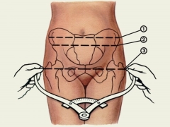 Pelvis sempit semasa mengandung dan bentuk klinikalnya