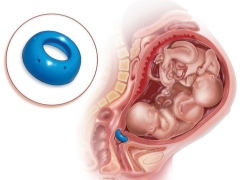Varför upprätta en obstetrisk pessary under graviditeten och när den är borttagen?