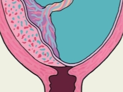 Vad betyder marginal placenta previa, vad är det farligt för och vad påverkar det?