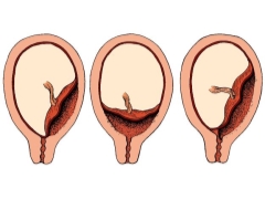 Vad är placenta previa och hur påverkar det graviditet och förlossning?