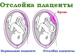 임신 말기의 태반 조기 박리의 증상 및 영향