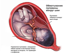 태아의 목에 탯줄을 얽히게하는 것이 위험하며 출산에 어떻게 영향을 줍니까?