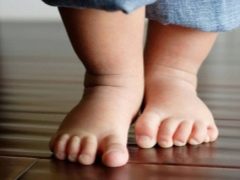 Exercises for valgus foot deformity in children