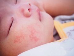 Bebeklerde ürtiker: belirtilerden tedaviye