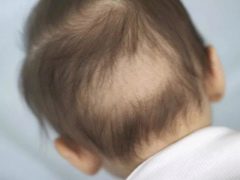 Hair falls out in infants: the causes and their elimination