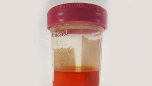 Red urine in a child
