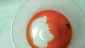 Blood in the urine of a child