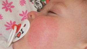 Liečba diatézy na lícach u dieťaťa