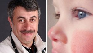 Dr. Komarovsky about red cheeks in a child