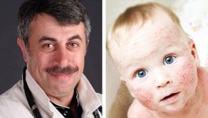 Dr. Komarovsky on the treatment of atopic dermatitis in children