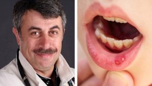 Dr. Komarovsky over stomatitis