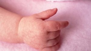 유아 및 신생아의 대리석 피부 : 원인, 증상 및 치료