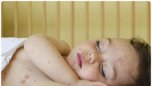 ماذا تظهر البقع على جلد الطفل؟