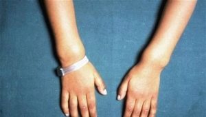 Signs and treatment of rickets in children older than one year