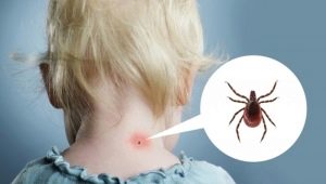 What to do if a child has been bitten by a tick?