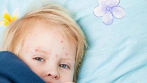 كيف يبدو طفح العدوى المعوية في الأطفال؟