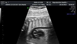 Biokemisk screening under första trimestern