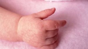 لماذا يمكن أن يظهر طفح جلدي في يد طفل وماذا يفعل؟